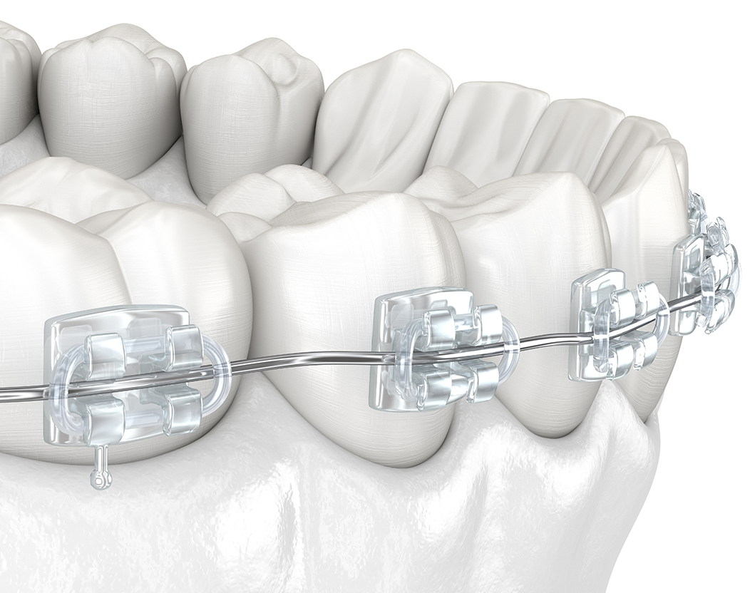 clear ceramic braces