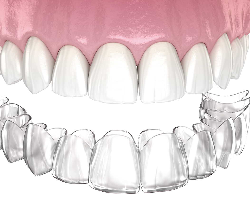 invisalign aligners