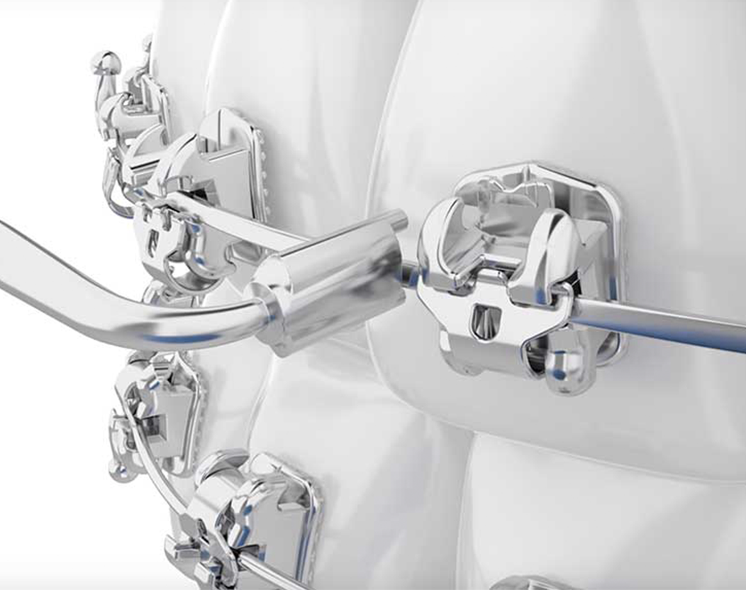 self-ligating braces